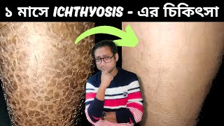 FISH SKIN বা ICHTHYOSIS কিভাবে সারাবেন [upl. by Hartmann]