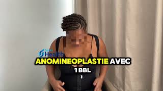 Témoignage d’une patiente satisfaite par sa liposuccion avec abdominoplastie et bbl avec SERVIHEALTH [upl. by Seroled868]