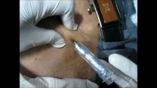 How To Give Goserelin Injection By Subcutaneous Mode [upl. by Che]