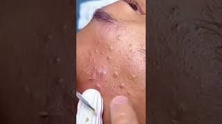 Huge Blackhead Extraction Extremely Satisfying [upl. by Okeim]