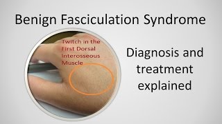 Benign Fasciculation Syndrome Causes and Treatment [upl. by Aprilette934]