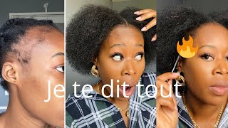 COMMENT FAIRE POUSSÉ SES CHEVEUX DU DEVANTAlopécieSolution Efficace [upl. by Melan]