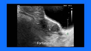 Fibroid vs LSCS Scar Dehiscence How Ultrasound and Doppler Make the Diagnosis [upl. by Yennep]