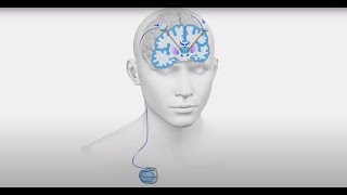 Deep Brain Stimulation DBS for Parkinson’s Disease Essential Tremor and Epilepsy [upl. by Asilana630]