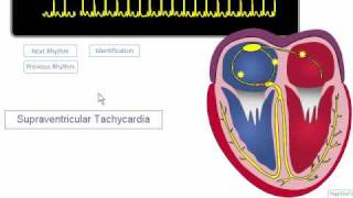 ECG Rhythm Review SVT Atrial Fibrillation Atrial Flutter [upl. by Kelcey583]