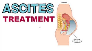 HOW TO TREAT ASCITES FAST ASCITES TREATMENT OPTIONS [upl. by Aan151]