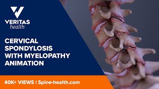 Cervical Spondylosis with Myelopathy Animation [upl. by Esinehc]