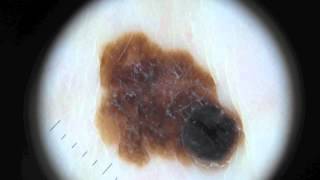 Moles and Melanoma [upl. by Harv939]