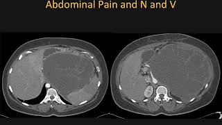 Mucinous Cystic Neoplasm MCN of the Pancreas What You Need to Know – Part 2 [upl. by Aitsirk]