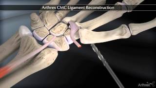 Arthrex CMC Ligament Reconstruction [upl. by Trill615]