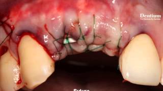 GBR on upper Anterior Esthetic area [upl. by Arik598]