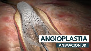 Procedimiento de Stent Paso a paso  Angiolastia  Animación 3D [upl. by Nevai]