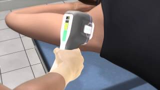 miraDry  a treatment for axillary hyperhidrosis or excessive underarm sweating [upl. by Anicul]