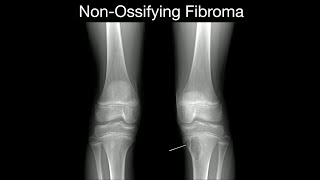 NonOssifying Fibroma 1 [upl. by Allegna]