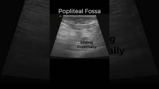 Popliteal Sciatic Nerve Block emergencymedicine regionalanesthesia POCUS FOAMed FOAMus [upl. by Teahan356]