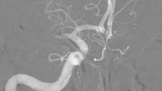 Imaging of Acute Ischemic Stroke the basics [upl. by Sekofski785]