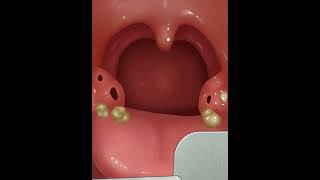 Treatment of oral gingivitis asmr shorts [upl. by Ogren949]