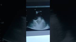 Pleural effusion on ultrasonography [upl. by Ephrayim]