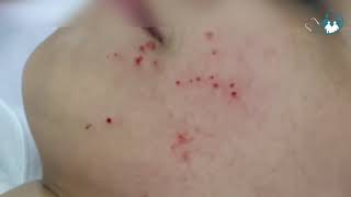 Molusco Contagioso  Ep 01 curetagem em paciente de 11 anos [upl. by Queri155]