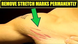 How To Get Rid Of Stretch Marks  4 Easy Tips To REMOVE STRETCH MARKS [upl. by Lamori479]