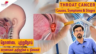 Throat Cancer Causes Symptoms Stages  Tamil [upl. by Eisoj]