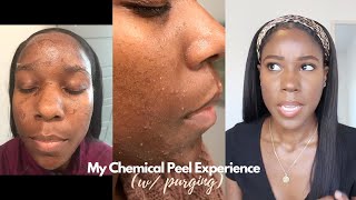 My Chemical Peel Experience Purging Before amp After  Jamila Nia [upl. by Pansy686]