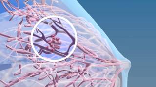 Breast Cancer  3D Medical Animation  ABP © [upl. by Akirea]