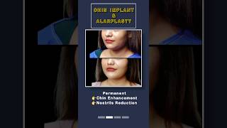 Defined Jawline amp slimmer nose  Chin Implant amp Alarplasty  Sarayu Clinics [upl. by Eiduam]