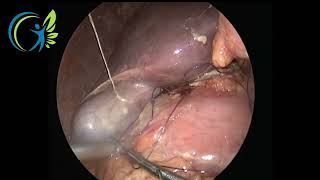 Laparoscopic Grams patch repair of Prepyloric Perforation [upl. by Conley]