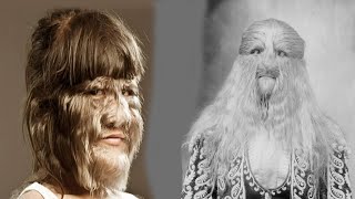 The TERRIFIC History of Hypertrichosis [upl. by Eldreda439]