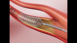 Angioplastia Carotídea [upl. by Ramad]