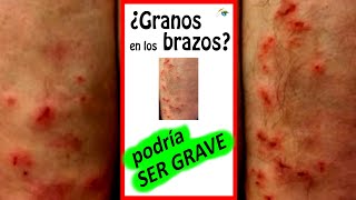 💥 GRANOS en los BRAZOS que PICAN 💥 Ampollas 💥 PICOR en la PIEL Dermatitis Herpetiforme FOTOS Shorts [upl. by Yellat]