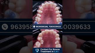 Braces Treatment Timelaps dentist facts dentalhygiene dentalclinic [upl. by Adnael]