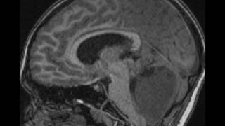 Medulloblastoma [upl. by Rima]