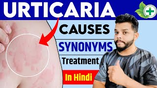 Urticaria Causes Symptoms Treatment In Hindi  Allergy In Hindi [upl. by Marceau]