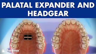 Orthodontic devices  Palatal expander and headgear © [upl. by Atinnek795]