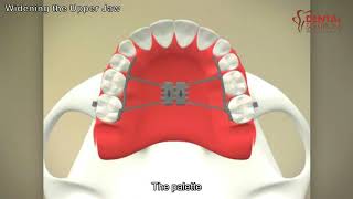 Widening the Upper Jaw  Palatal Expanders [upl. by Zetrok]