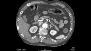 Aortic Dissection  QMH AED Ultrasound Casebook 201409 Video 7 [upl. by Aldridge524]