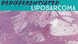 Dedifferentiated liposarcoma with heterologous osteosarcoma component [upl. by Missak]