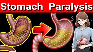 Stomach Paralysis 5 Warning Signs You Shouldnt Ignore Gastroparesis [upl. by Atinod908]