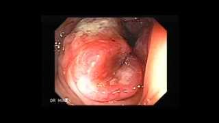 Colonoscopy of Colon Cancer [upl. by Nyar775]