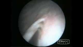 Endoscopic treatment for VUReflux  Deflux Injection [upl. by Ricoriki242]