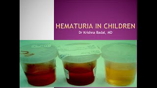 Hematuria in children [upl. by Nylahsoj149]