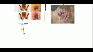 Hemorrhoids Lecture for USMLE [upl. by Atteuqehs]