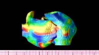 Atrial fibrillation simulation in an anatomical human atria [upl. by Savina5]