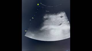 Congestive heart failure on ultrasound comedy trending babyradiology ultrasound viralshorts [upl. by Silda]