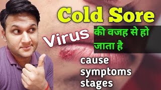 Cold Sore part1 cause symptoms and stages [upl. by Riella860]