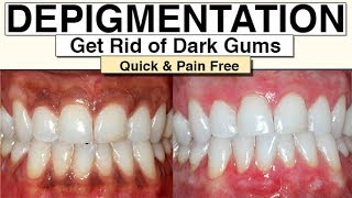 Black Gums How To Get Rid Of Them With Gum Depigmentation [upl. by Iinden303]