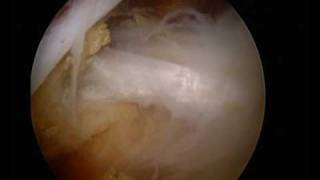 UK Surgeon  wwwshouldersurgeryorguk  Arthroscopic Suprascapular nerve decompression [upl. by Llirred595]