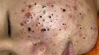 Big Cystic Acne Blackheads Extraction Blackheads amp Milia Whiteheads Removal Pimple Popping  6790 [upl. by Haron]